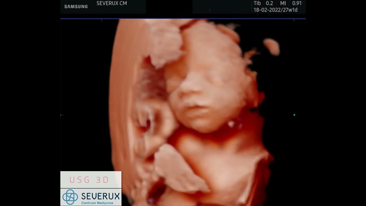 USG 3D ciążowe - CM Severux