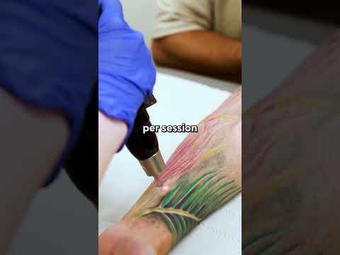 The REAL cost of Tattoo Removal in London | #tattooremoval #tattoos #lasertattooremoval #skincare