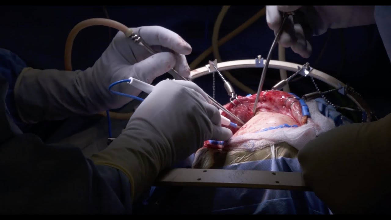 Pterional Craniotomy