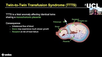 IPCAI 2020 Talk on Recurrent Convolutional Network for Occlusion Identification in Fetoscopic Videos