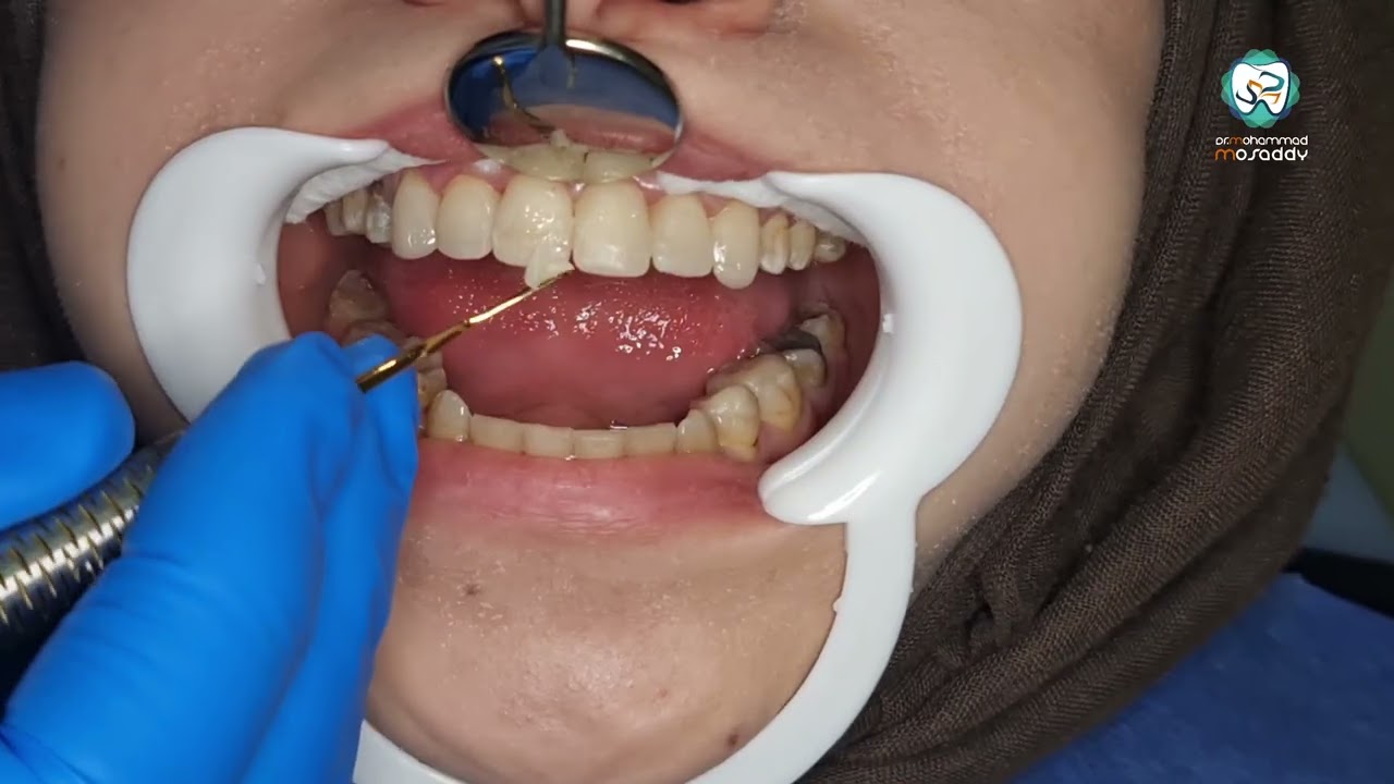 كيف بتحدد طول السن بالنسبة للعرض The ratio of tooth length to width
