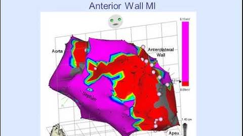 Using Substrate and Entrainment Mapping in Catheter Ablation of Scar-Based Ventricular Tachycardia