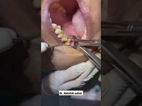 اسرع خلع ضرس في العالم خلع ضرس بدون الم Extraction Teeth