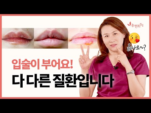 Why You Need to Distinguish Between Lip Swelling Conditions: Cheilitis vs. Angioedema vs. Herpes