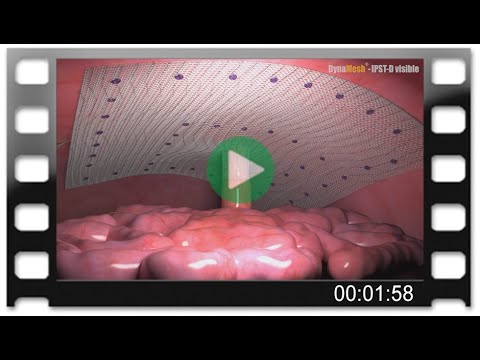 DynaMesh-IPST-D visible: Parastomal Hernia Repair (Chimney)