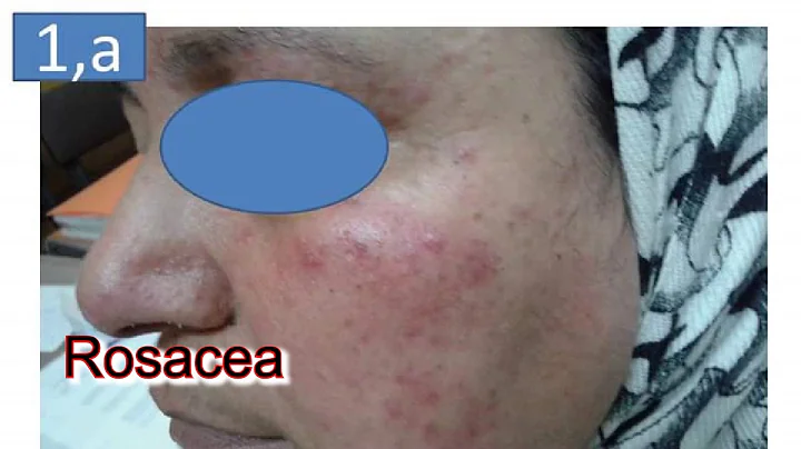 Differential  diagnosis  between rosacea and  LMDF...