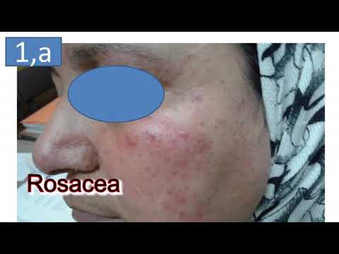 Differential  diagnosis  between rosacea and  LMDF by Dr : Mohamed Moustafa Fawzy