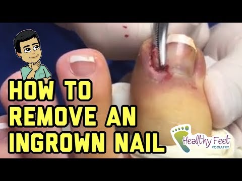How to Remove an Ingrown Nail. Ingrown Nail Removal. 