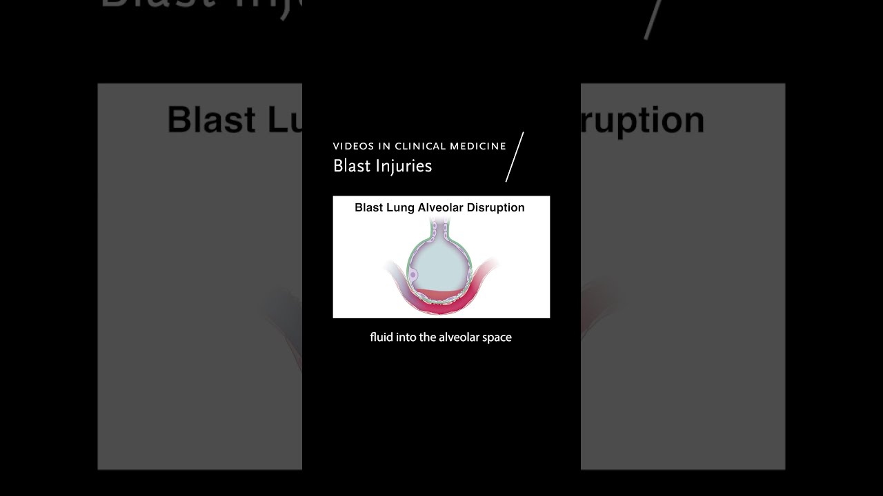 Videos In Clinical Medicine Blast Injuries Pulmonary 