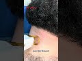 Laser Hair Removal Treatment #viralvideo #hair #haircare #hairtreatment #getsmarthairclub