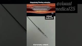 3D animation  angioplasty stenting for heart attack #cardiology #medicaleducation