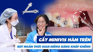 Cấy minivis hàm trên - Rút ngắn thời gian niềng răng khấp khểnh | Nam Bùi Vinalign
