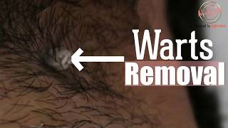 मस्से को जड़ से हटाने का सबसे अच्छा उपाय | Warts Removal Treatment | Dadu Medical Centre