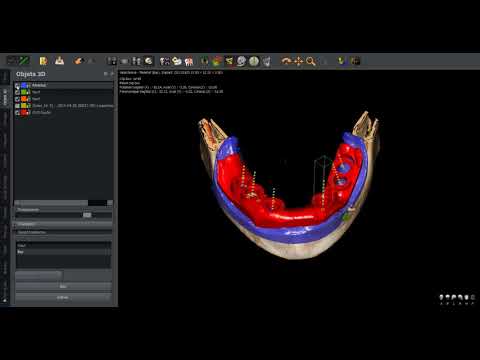 Guided surgery : endentulous case