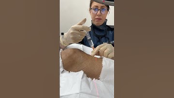 🏋️‍♀️ How is genicular nerve block done?