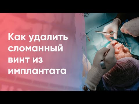 Как просто и эффективно удалить сломанный винт из имплантата