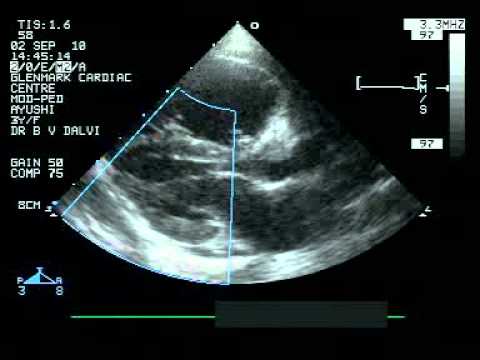 2d echo echocardiogram doppler