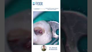 C-Root Sp With Dr. Ahmad Ai Abdullahtotal Seal, Total Heal