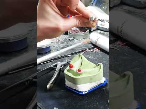 Telescope Denture