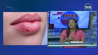 Herpes labiales: Causas, sintomas y tratamiento, con la #Dra.KatherinMedina, #TeleSalud