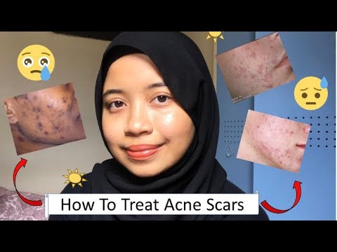 Acne Scars & How to Treat Them!