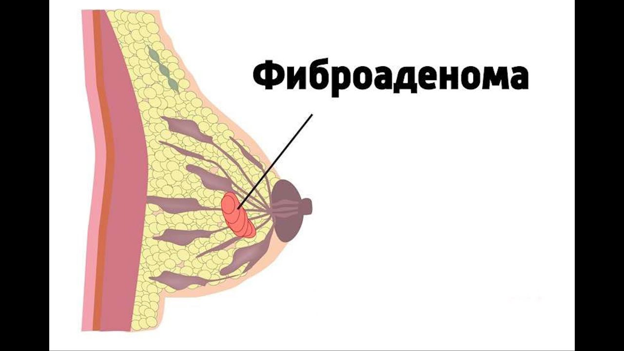 Фиброма в груди. Фиброаденома молочной железы. Фиброаденома в молочной железе.