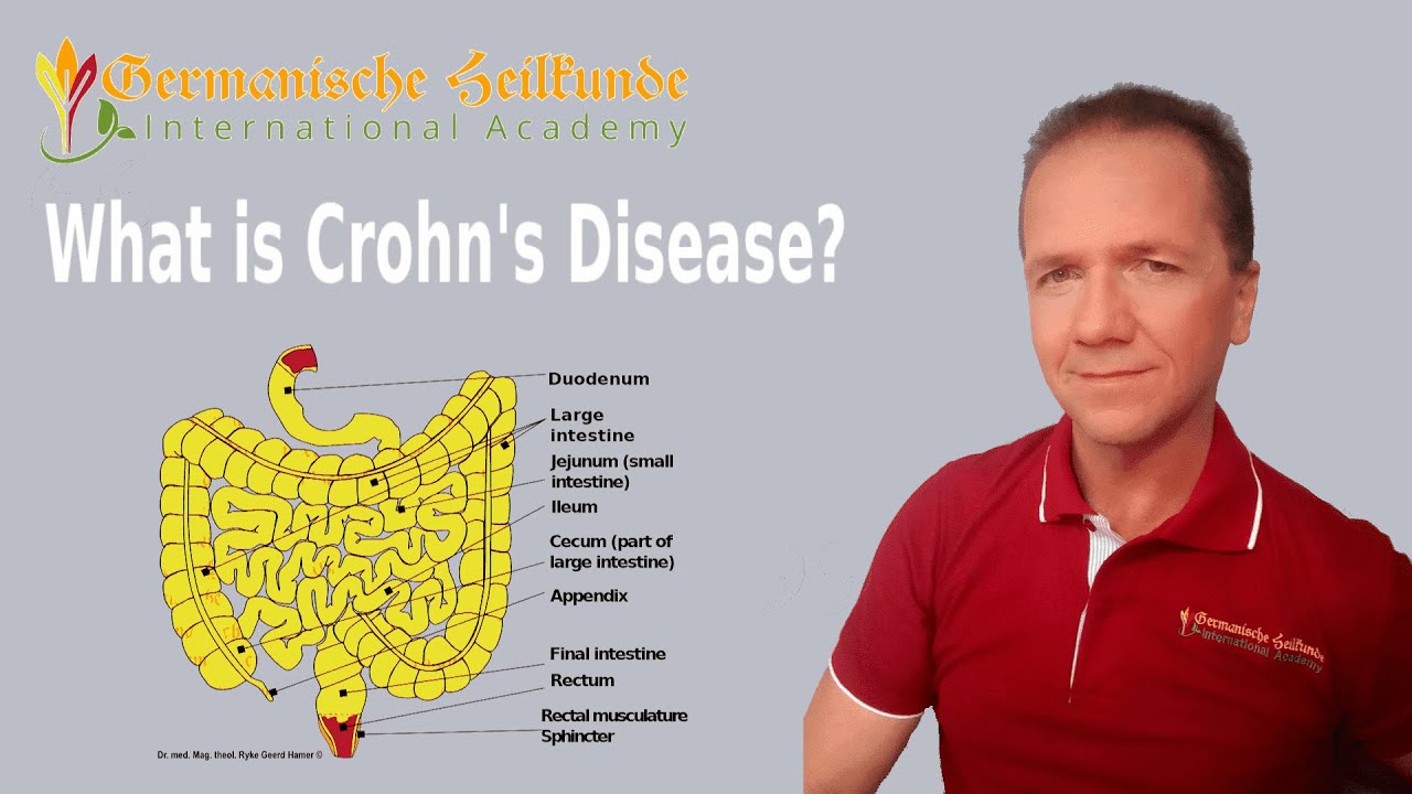 What is Crohn's Disease? German New Medicine Explanation YouTube