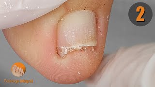 [2nd video] 7 months later already recovered from onychocryptosis | Total nail trimming and cleaning