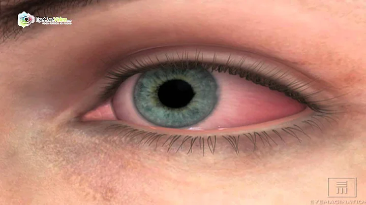 Dr. Michelle L. Frye - Dry Eyes