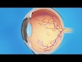 Detached Retina: Pneumatic Retinopexy