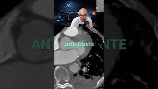Descubre el Trombo Crónico: Ángulos y periferia