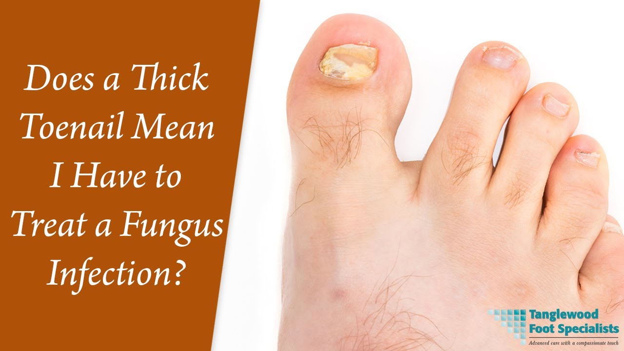 Does a Thick Toenail Mean I Have to Treat a Fungus Infection