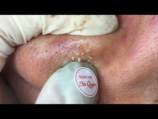 Acne treatment in Ha Quyen Spa on 02/08/2019 - Điều trị mụn tại Hà Quyên Spa