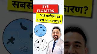आँख में 'Weiss Ring' क्या है? 👁️ PVD Explained