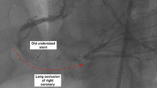 Chronic total occlusion (CTO) PCI to occluded right coronary artery (Central Heart)