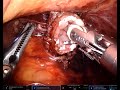ROBOTIC TOTAL GASTRECTOMY RECONSTRUCTION WITH ROUX EN Y ESOPHAGOJEJUNOSTOMY