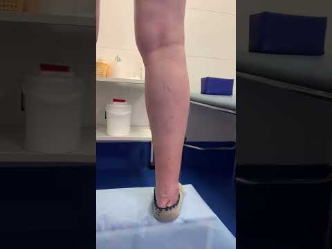 #лечениеварикоза #флебологмосква #флеболог #шортс #варикоз_как_избавиться #полезности #допосле