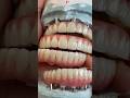 Full Arch Zirconia restoration for Dr. Samantha Chou in Illinois