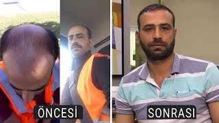 Dhi Tekniğiyle Saç Ekimi - Clinicexpert