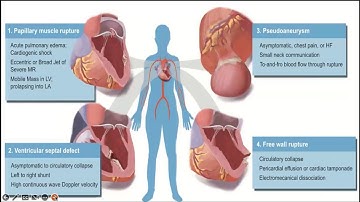 Echo Assessment of Post Acute Myocardial  Infarction Mechanical Complications