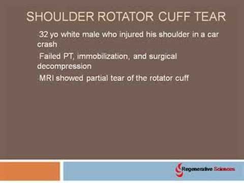 rotator cuff stem cell treatment rotator cuff stem cell treatment
