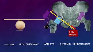 Hip Joint Biomechanics and arthroplasty: Simplified Basics Part 1 of 3