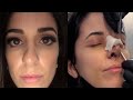 MY NOSE JOB REVEAL & 2 WEEKS POST OP | Revision Rhinoplasty Experience in Turkey | (Dr. Umit Taskin)
