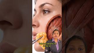 Buccal fat removal