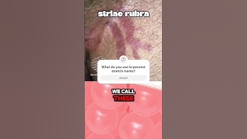 How Stretch Marks Work #evidence #research #dermatologist #shorts