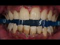 Dental Calculus Removal | Dentist | Dokter Gigi Tri Putra