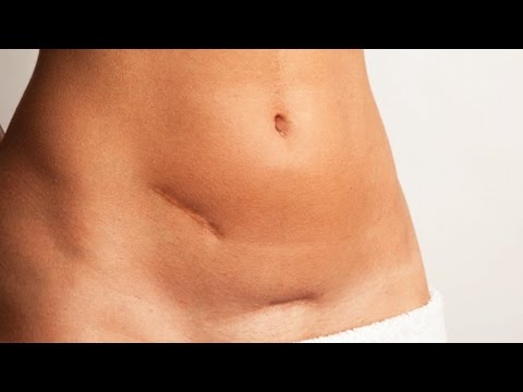 Yara İzi Nedir, Tedavileri Nelerdir ?  Yrd. Doç. Dr. Ahmet Kahraman