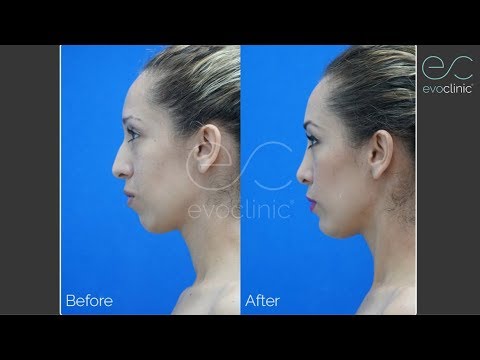 Video thumbnail: Carol: Rhinoplasty & Chin Implant Patient Transformation by Dr. José L. Salas — evoclinicmx