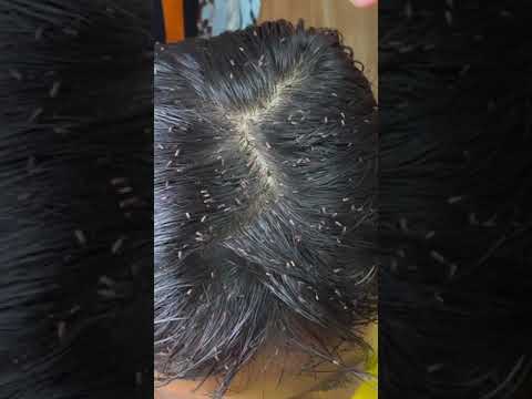 Picking a thousand of lice on hair - How to remove lice