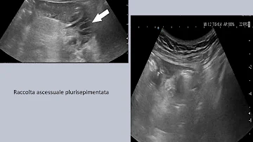 Cosa si vede da ecografia intestinale?